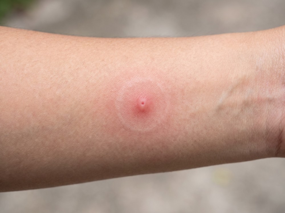 Close-up photo of a fresh brown widow spider bite showing a small red welt with a pale center on skin
