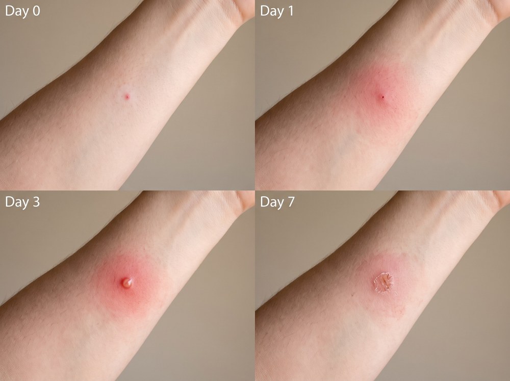 Side-by-side labeled comparison photo of a brown widow spider bite and a black widow spider bite on skin